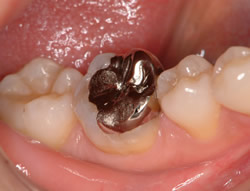 銀歯による修復