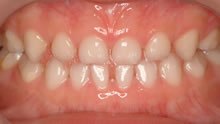 乳歯列は隙間があった方が永久歯の歯並びの問題が生じにくい