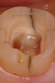 感染した歯髄（神経）は除去し、根管内の消毒もしくは破折歯根を抜去する必要がある
