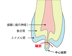 中心結節を持つ歯のイラスト