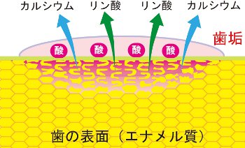 エナメル質脱灰のイラスト