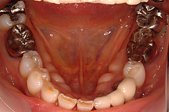 下顎小臼歯部舌側にできた骨隆起