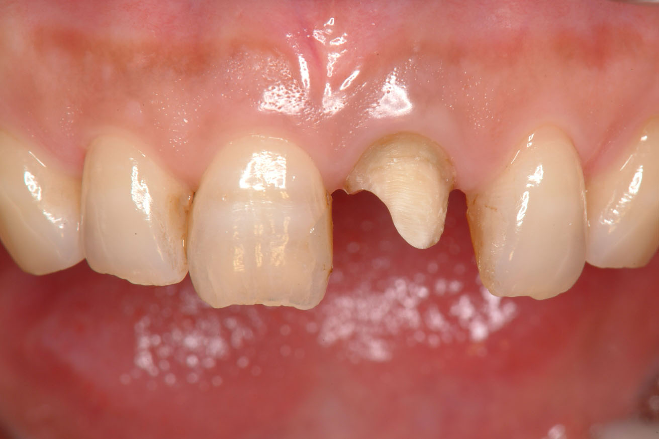 クラウンとメタルコア除去後．失活歯（歯髄の無い歯）は茶色く変色しやすい