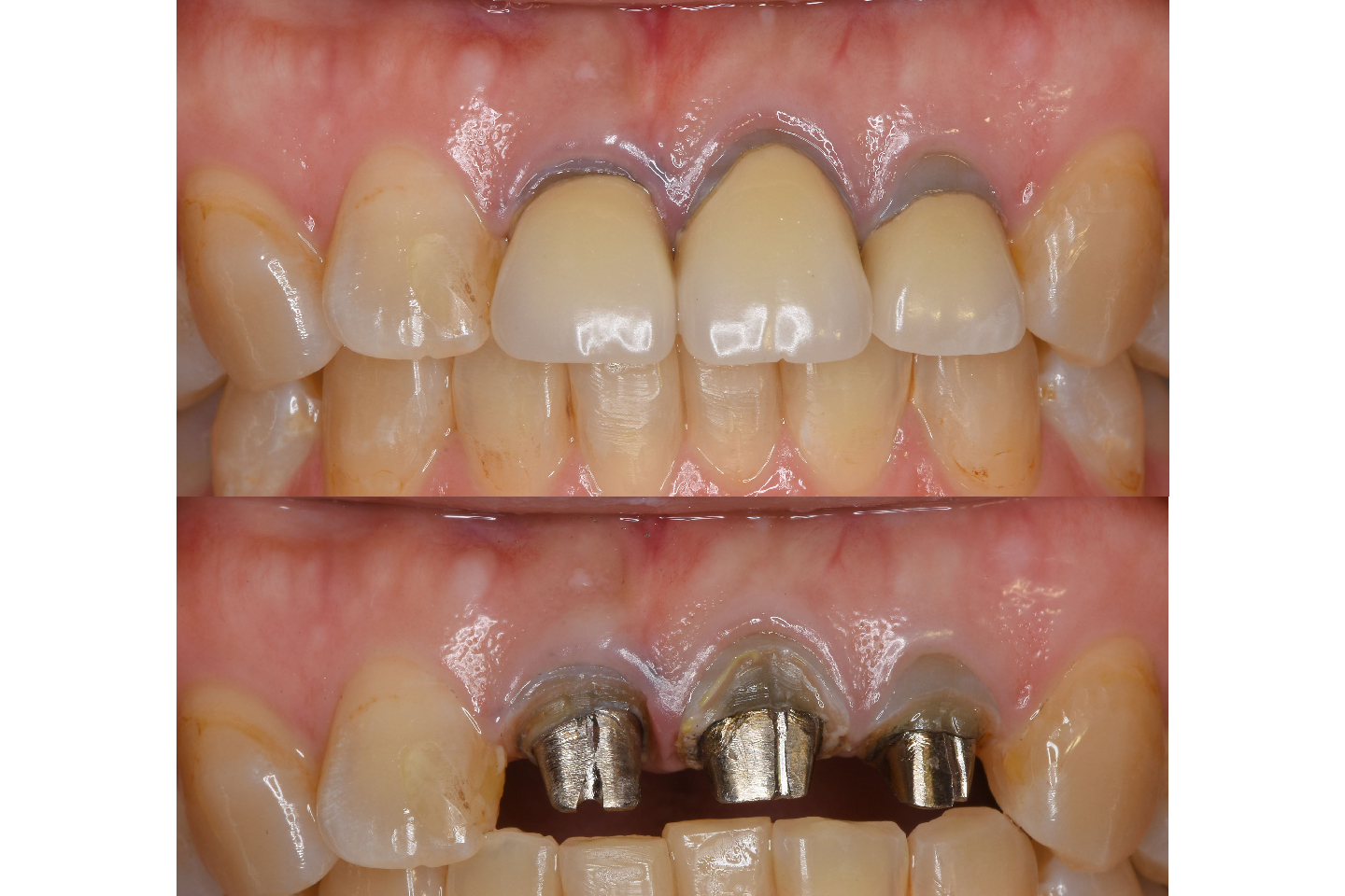 歯頸部の変色の典型例