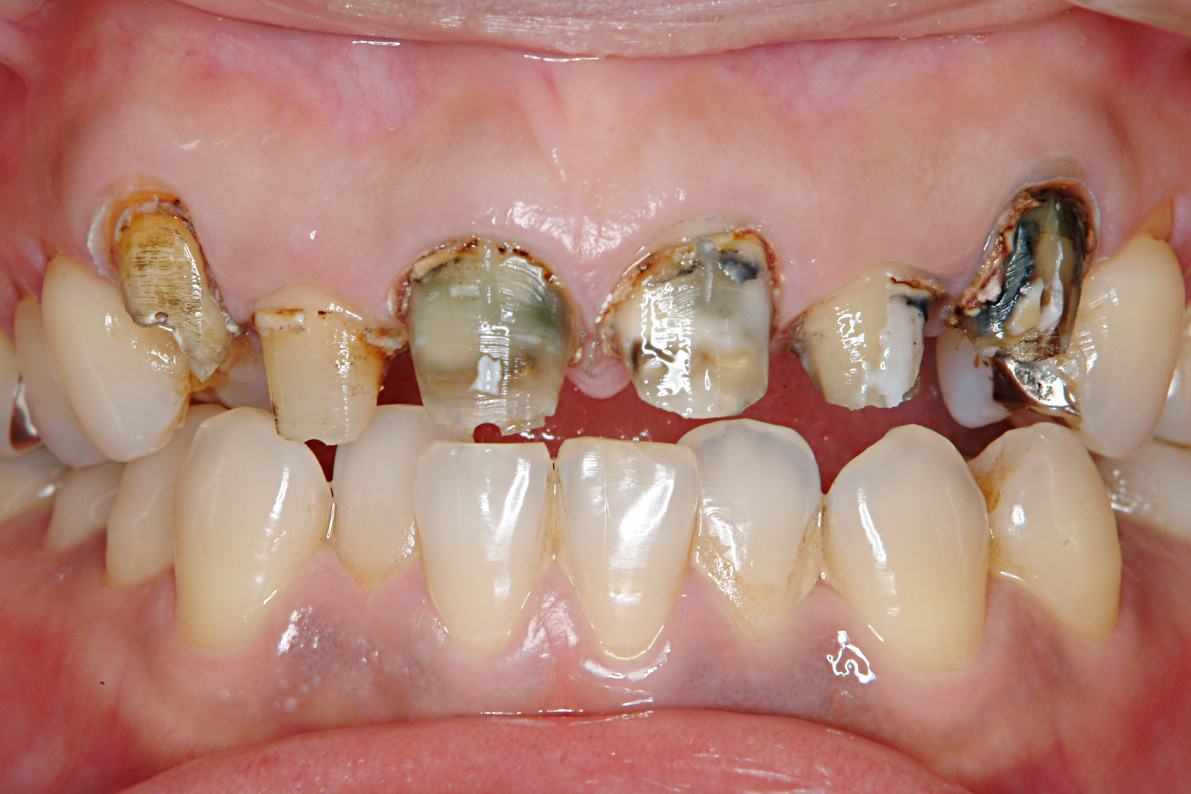 差し歯の根元が茶色く変色して見た目が悪い場合の治療について