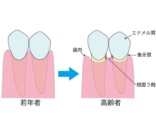 図1　高齢者になって歯肉がやせてくると歯根が露出して根面う蝕になりやすい