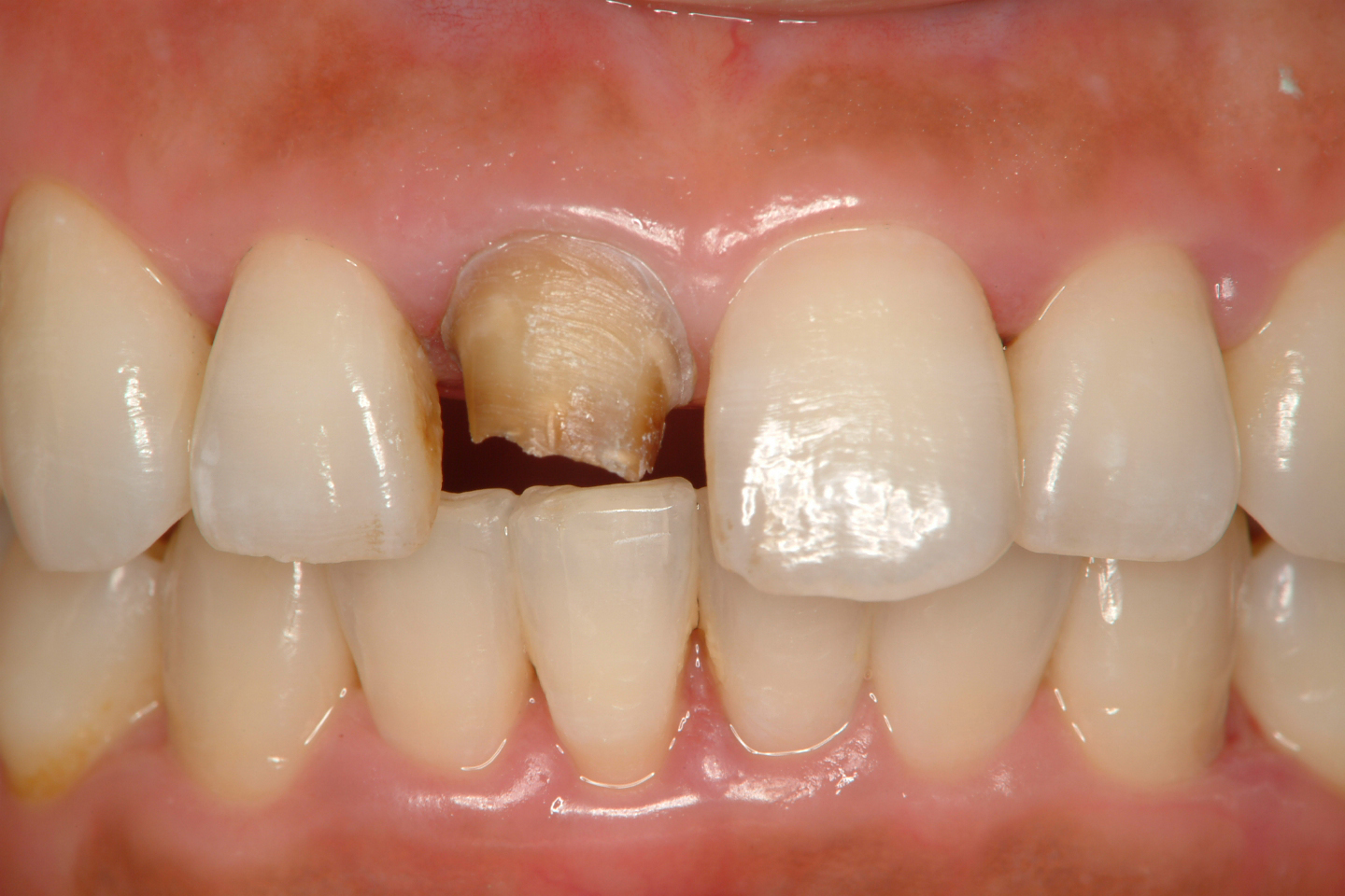 図3　セラミックとコア除去後歯質が茶色く変色している