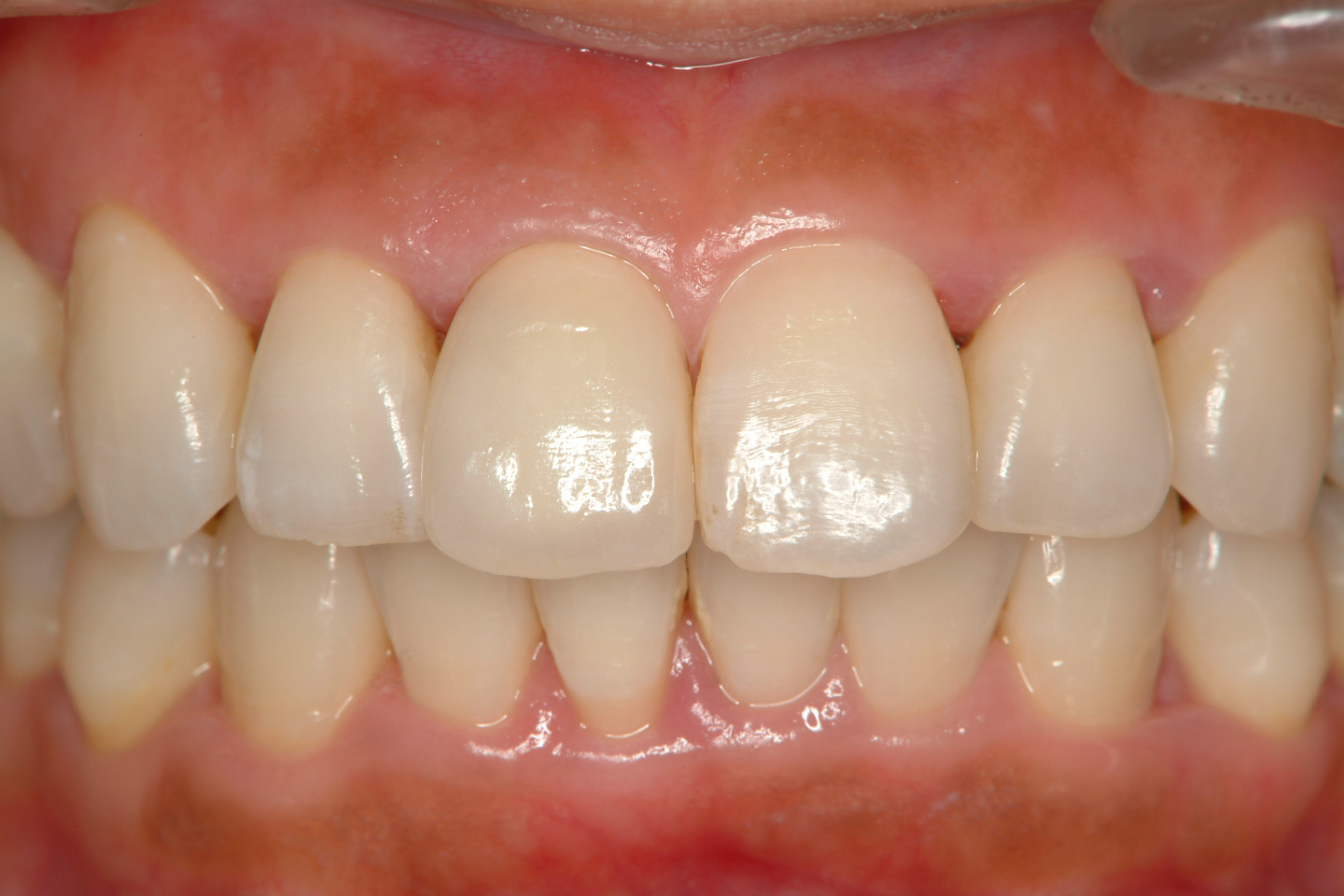 図6　術後術前と比較して歯肉の色も改善している