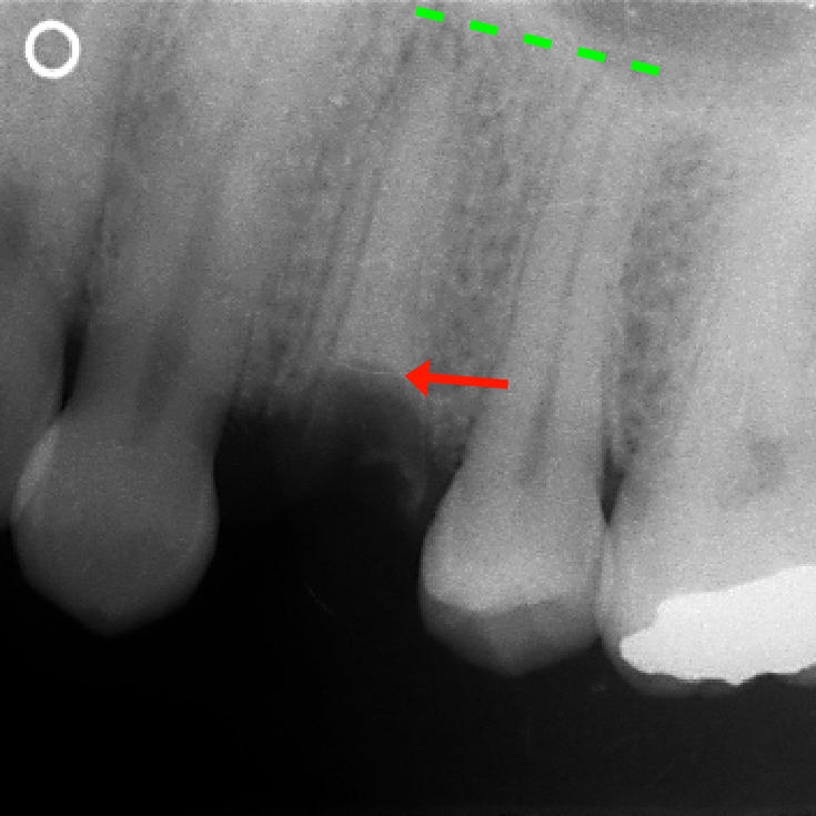 図1　術前のレントゲン．矢印の位置まで虫歯が進行しており、この状態で歯を残すことは困難