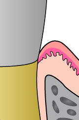 健康な歯肉のイラスト